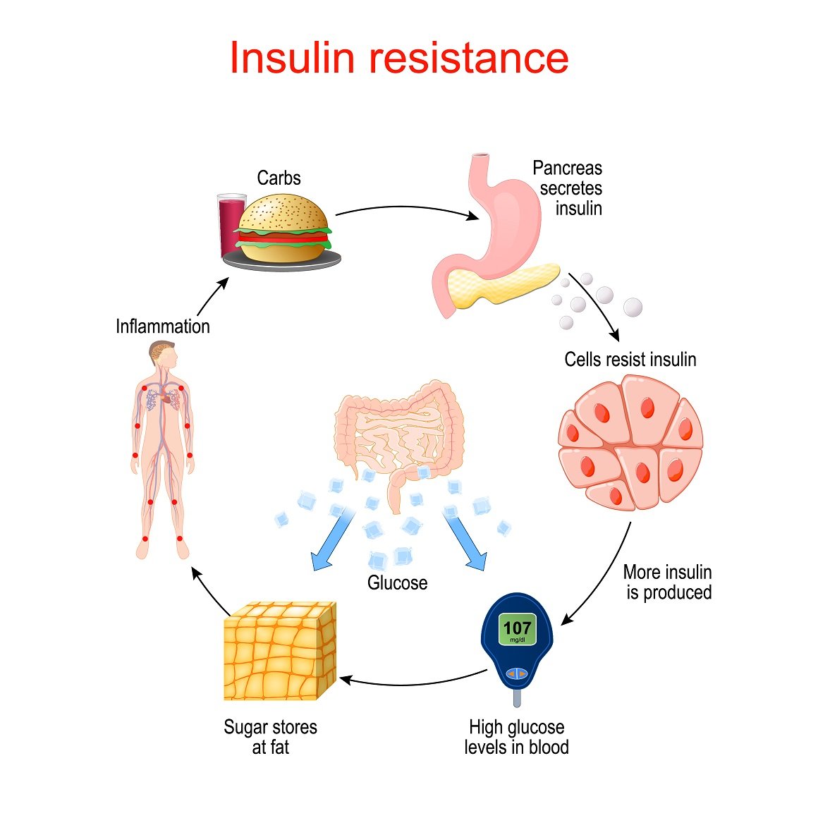 Insulin Resistance and Obesity